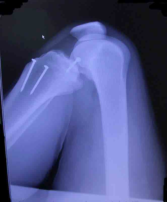 kneenails.jpg