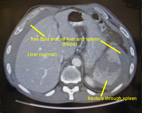 splenic-fx-copy.jpg
