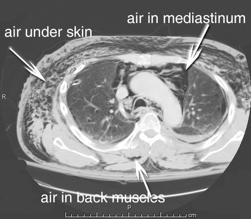 sqemphysema1.jpg